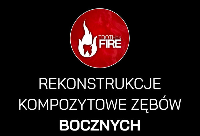 REKONSTRUKCJE KOMPOZYTOWE ZĘBÓW BOCZNYCH